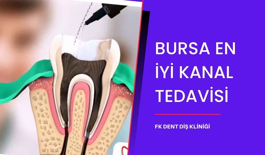 Bursa En İyi Kanal Tedavisi